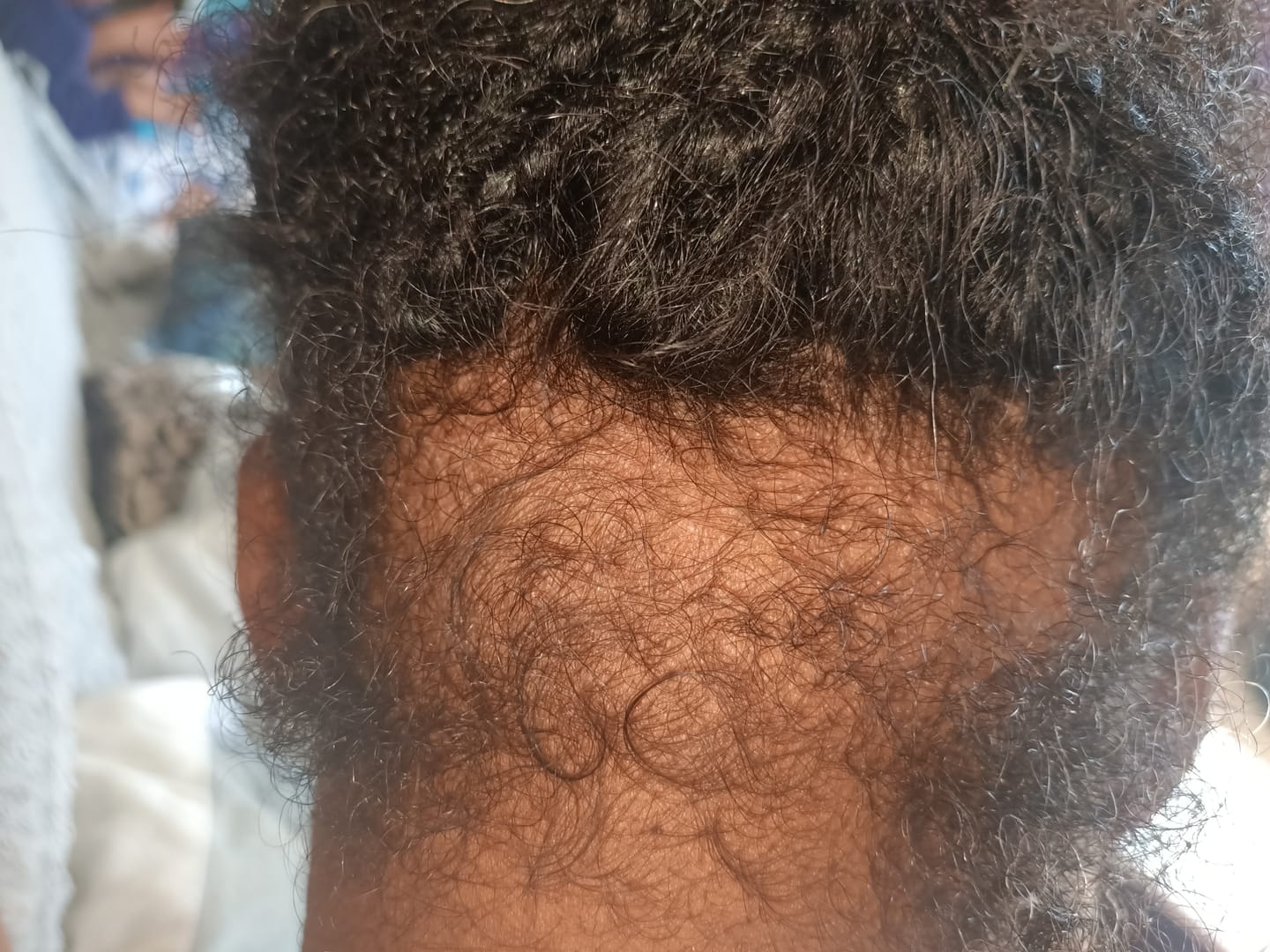 Customer photo review of Sérum Capiboost Hibiscus & Orties 120ml pour la pousse des cheveux bouclés frisés crépus