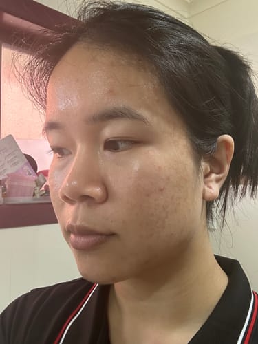 Customer photo review of Advanced Acne Program™