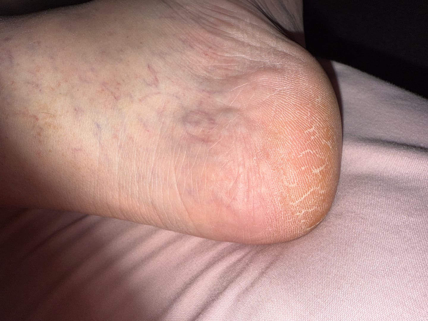 Customer photo review of XL Foot File, Reviving Foot Cream, 2x Heel Socks Bundle