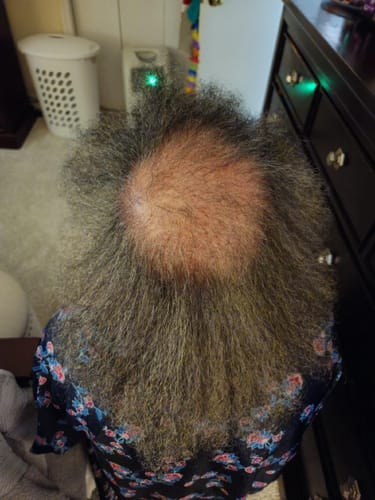 Customer photo review of Rennora EXTRA-Strength Hair Growth Serum