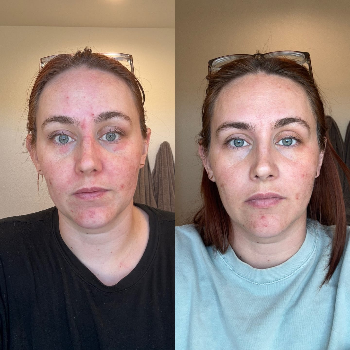 Customer photo review of The Complete Acne System for Women