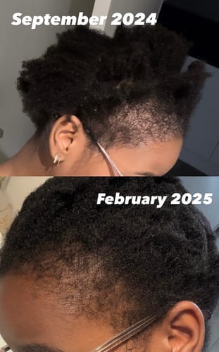 Customer photo review of Scalp Serum Set - Minoxidil