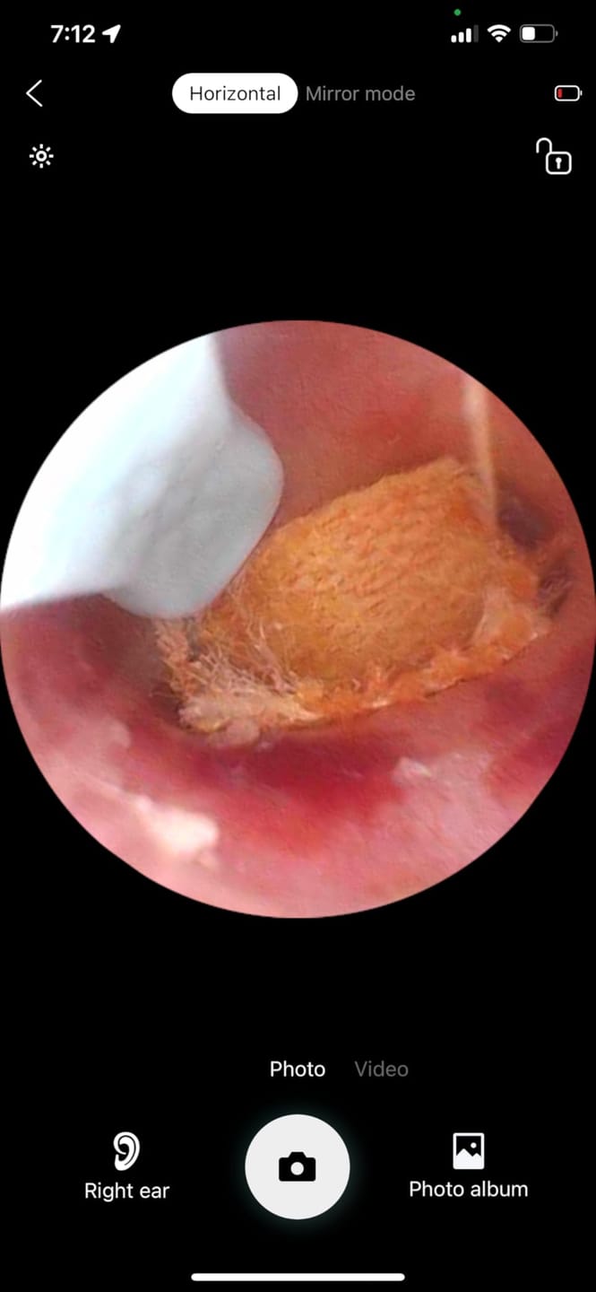 Customer photo review of ClearEar™ Earwax Removal Tool