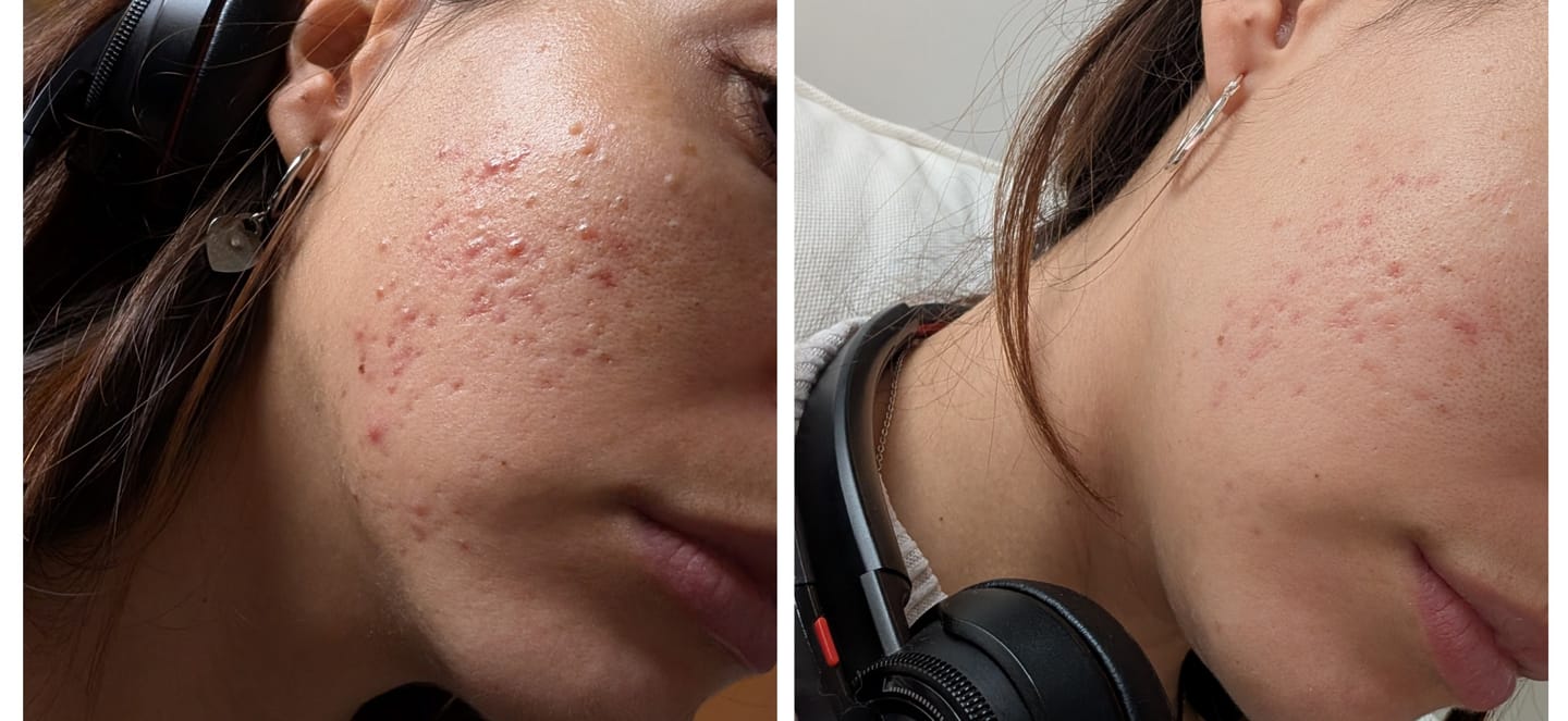 Customer photo review of A CONTROL - ACNÉ HORMONAL & RESISTENCIA A LA INSULINA