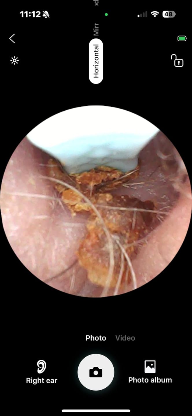 Customer photo review of ClearEar™ Earwax Removal Tool
