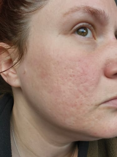 Customer photo review of Glov Micro Infusion System