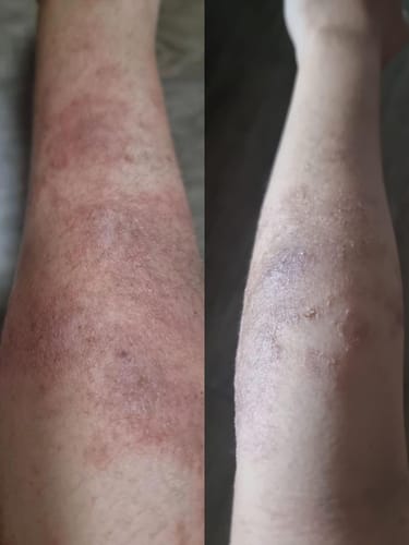 Customer photo review of Eczema Scratch Mitten