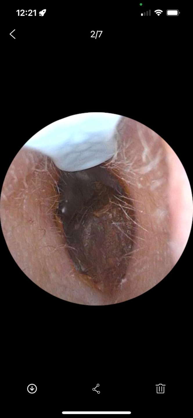 Customer photo review of ClearEar™ Earwax Removal Tool