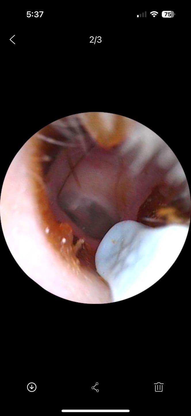 Customer photo review of ClearEar™ Earwax Removal Tool