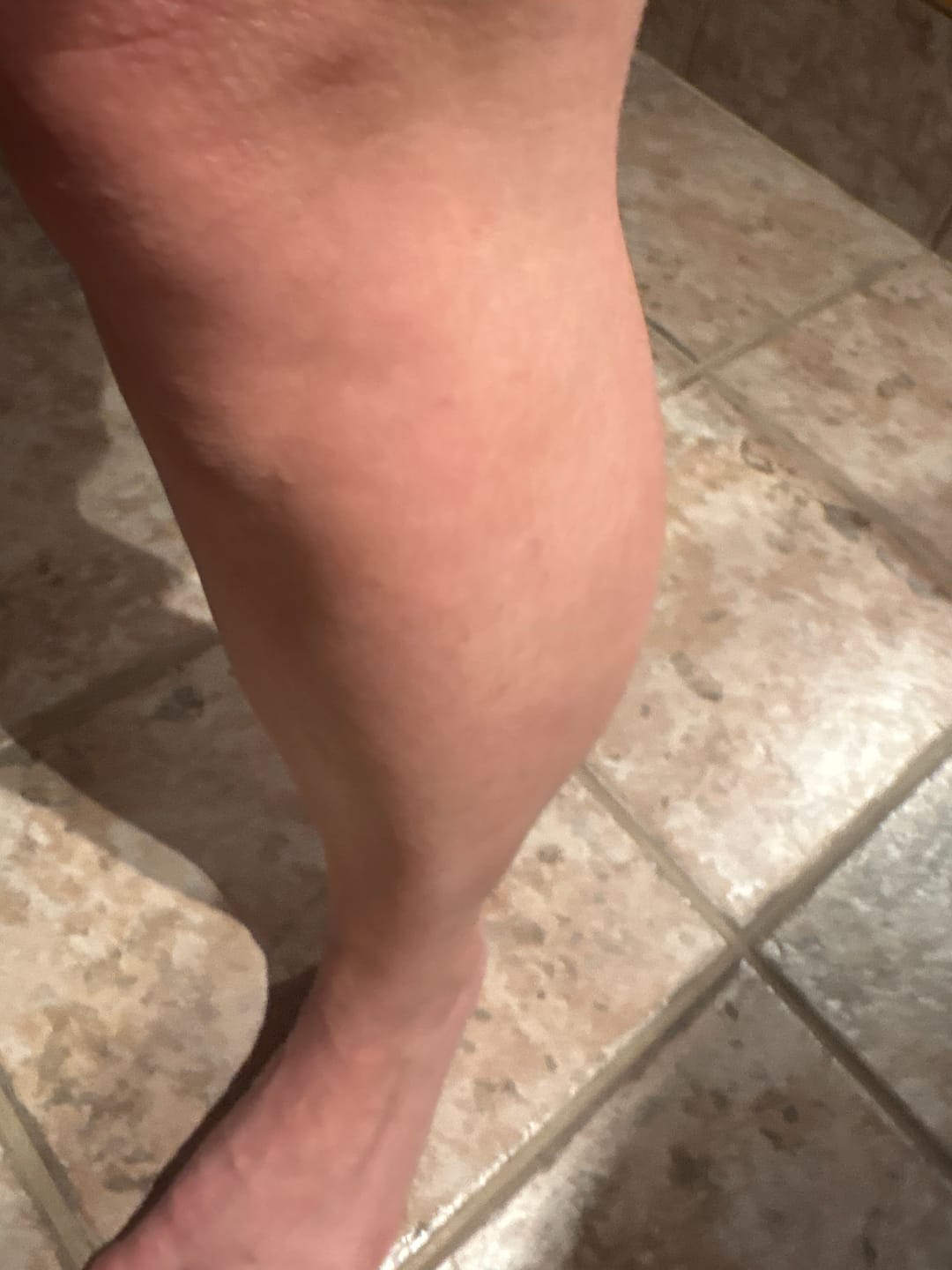 Customer photo review of Forfaits Avantages + Épilation Laser Clarity II