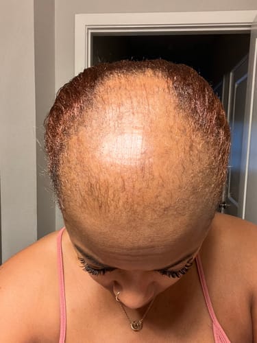Customer photo review of Healthy Hair Starter Kit- Limited Edition