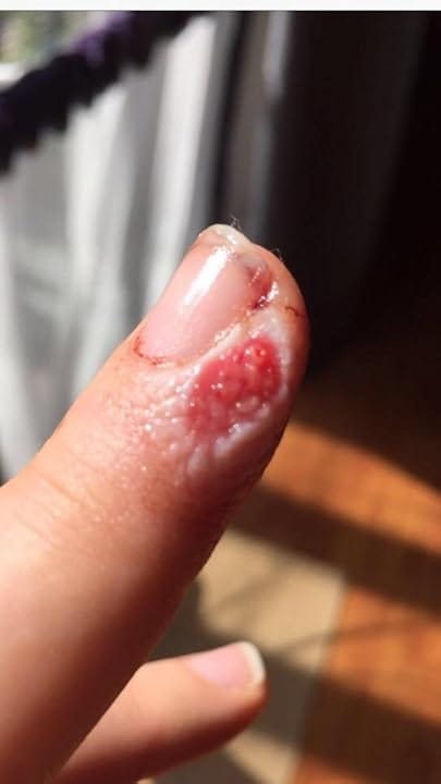 Customer photo review of The Wound Cleanser