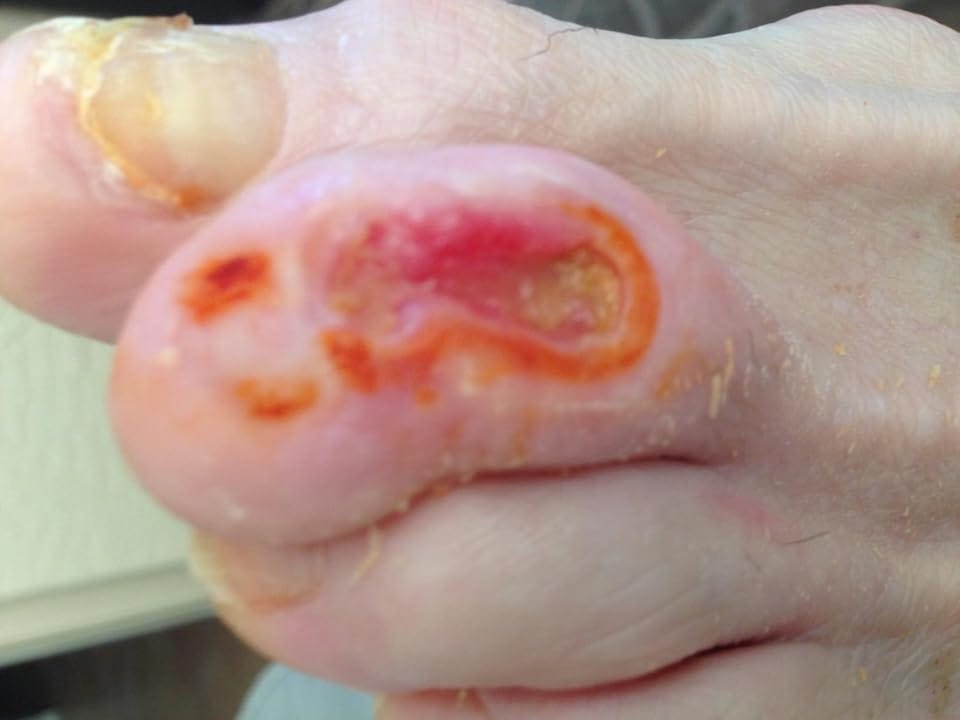 Customer photo review of The Wound Cleanser