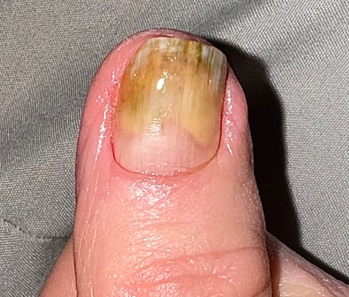 Customer photo review of Onychom - Antifungal Laser Device