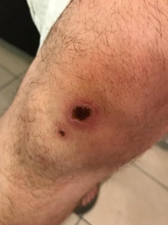 Customer photo review of The Wound Cleanser