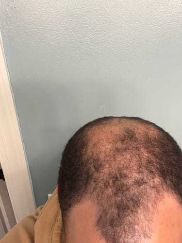 Customer photo review of Rennora Hair Growth Serum
