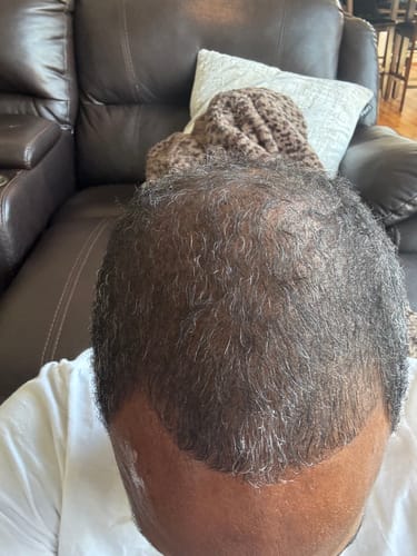 Customer photo review of Rennora Hair Growth Serum