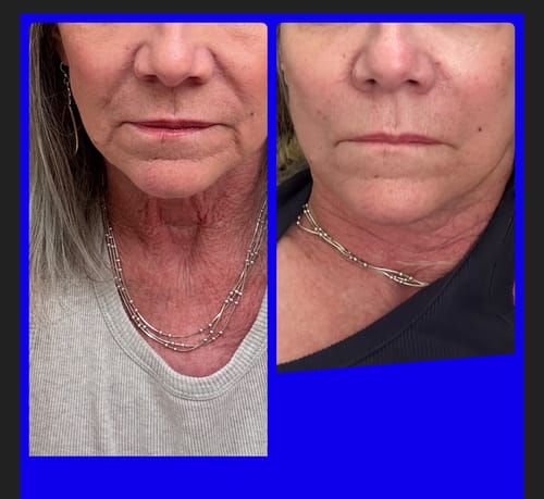 Customer photo review of Glov Micro Infusion System
