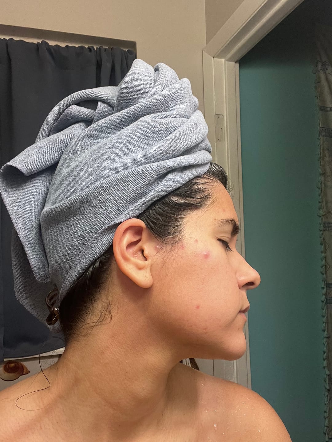 Customer photo review of The Complete Acne System for Women