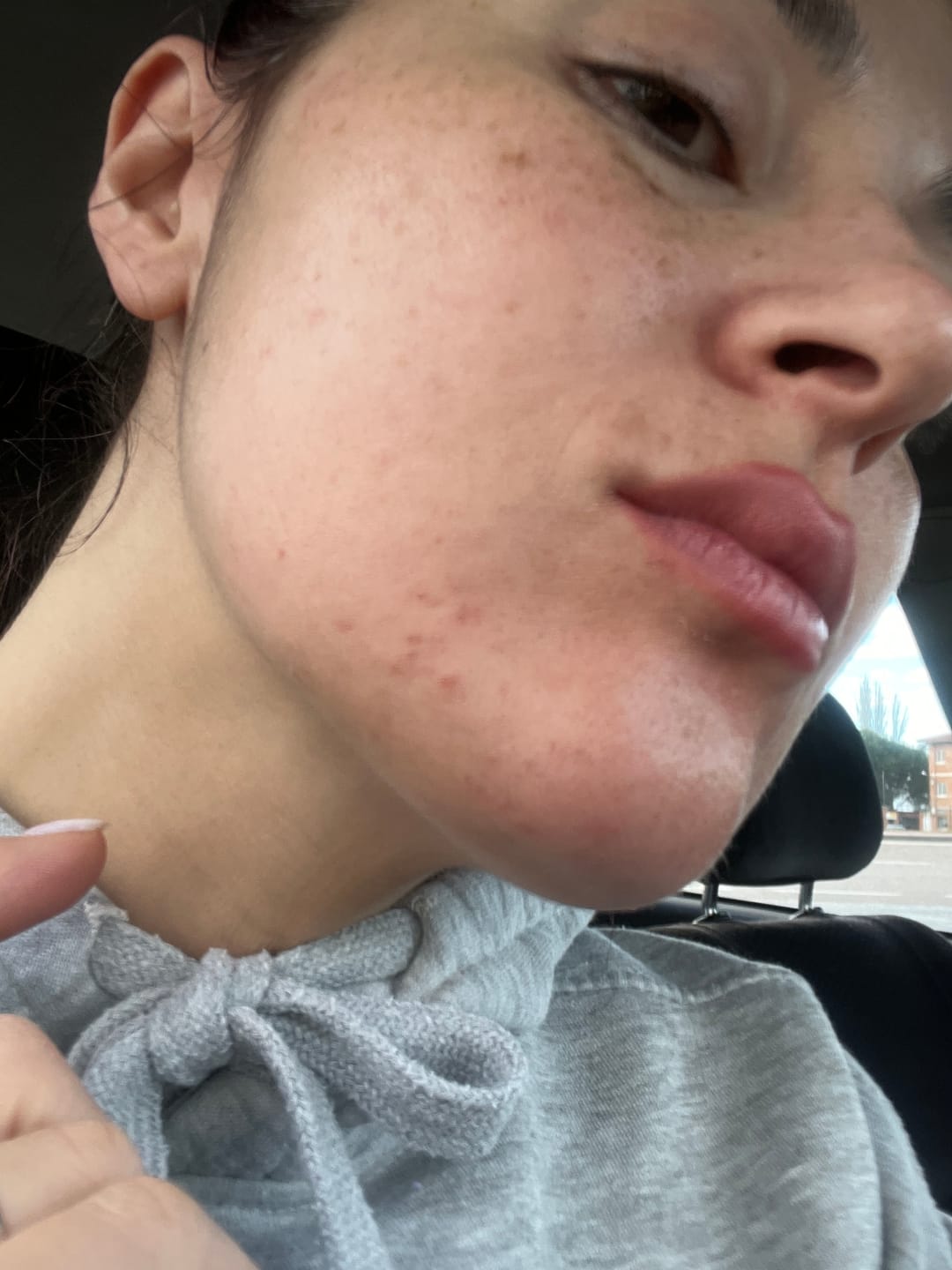 Customer photo review of A CONTROL - ACNÉ HORMONAL & RESISTENCIA A LA INSULINA