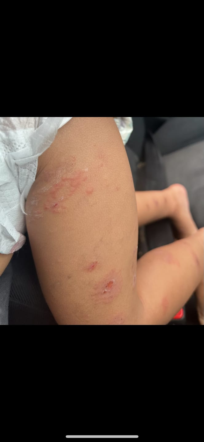 Customer photo review of Kawakawa Repair Balm - Winner, Best SOS/Healing Balm 2024