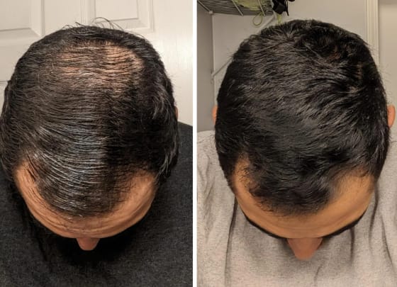 Customer photo review of Lanbena Hair Growth Serum