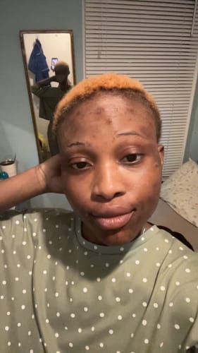 Customer photo review of Anti-Acne & Dark Spots African Soap