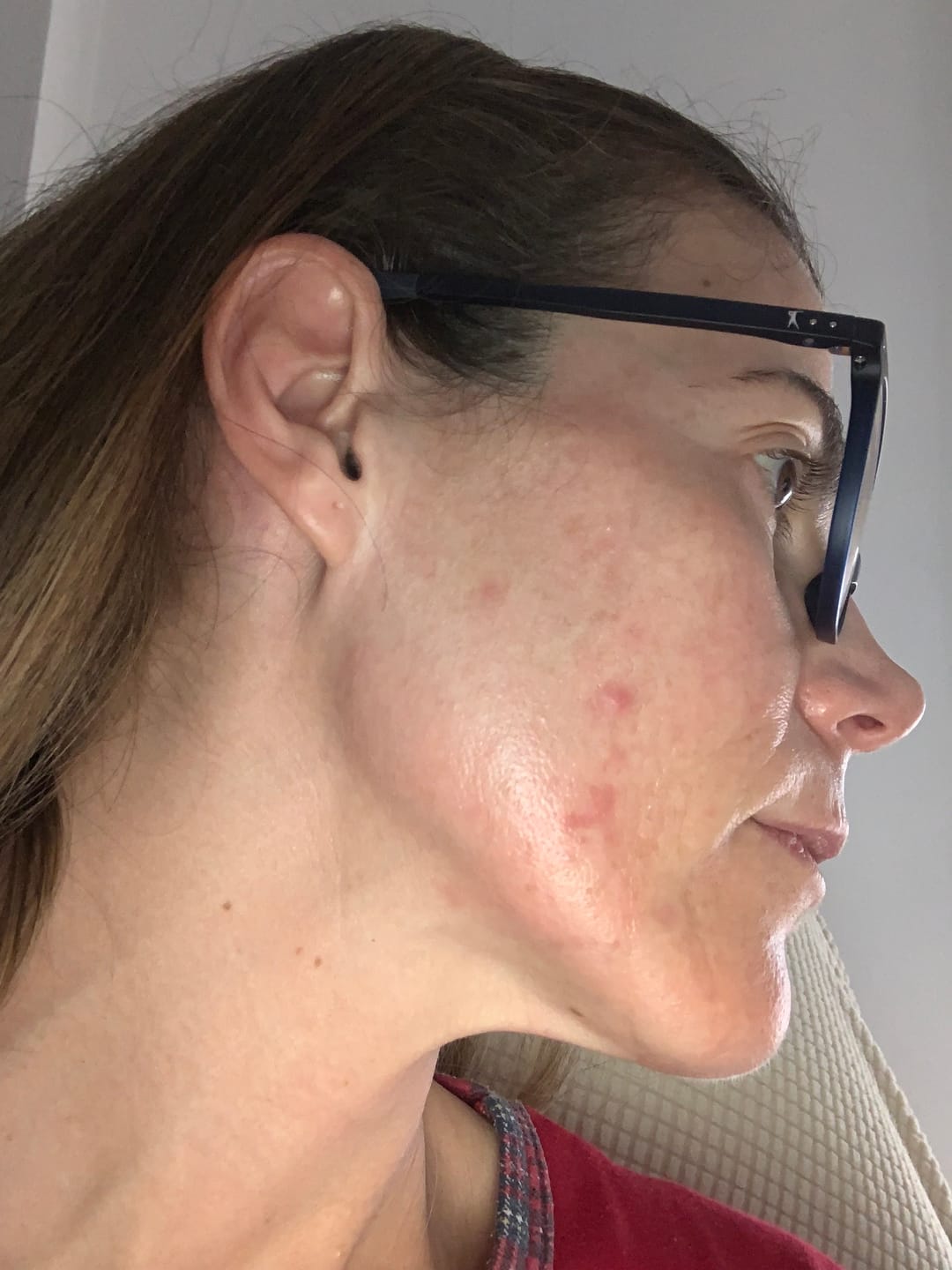 Customer photo review of A CONTROL - ACNÉ HORMONAL & RESISTENCIA A LA INSULINA