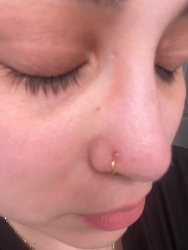 Customer photo review of Piercing Bump Treatment - Bump, Keloid & Scar Relief Oil