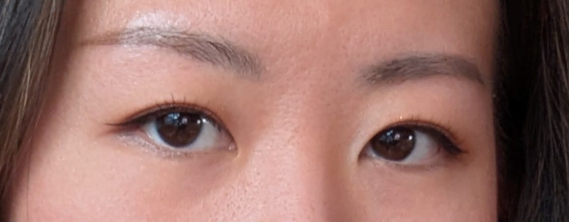 Customer photo review of Optifold Eyelid Tapes - Create Double Eyelids + Fix Uneven, Droopy, Hooded Eyelids