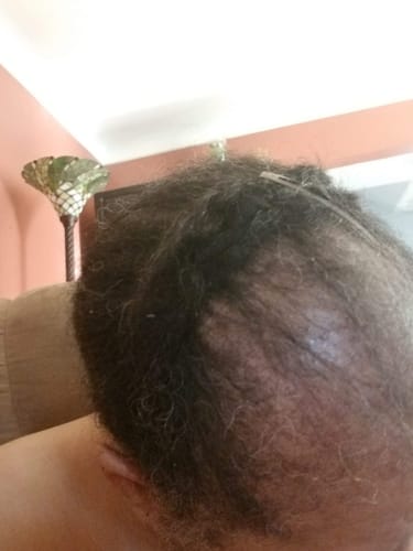 Customer photo review of Three Bottles of Allurium EXTRA-Strength Hair Growth Serum Auto renew