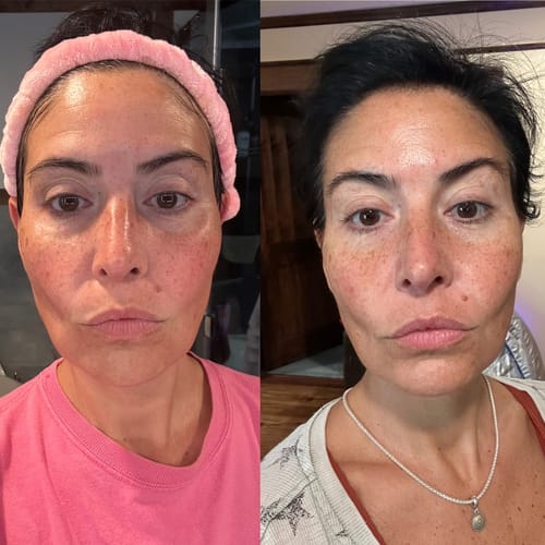 Customer photo review of Glov Micro Infusion System