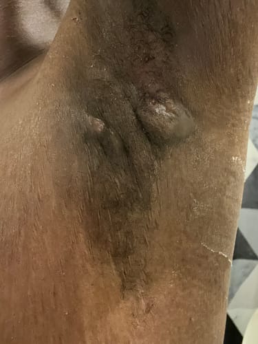 Customer photo review of Therapeutic Shea Butter - Fast Relief of Sore Muscles & Joints 4oz