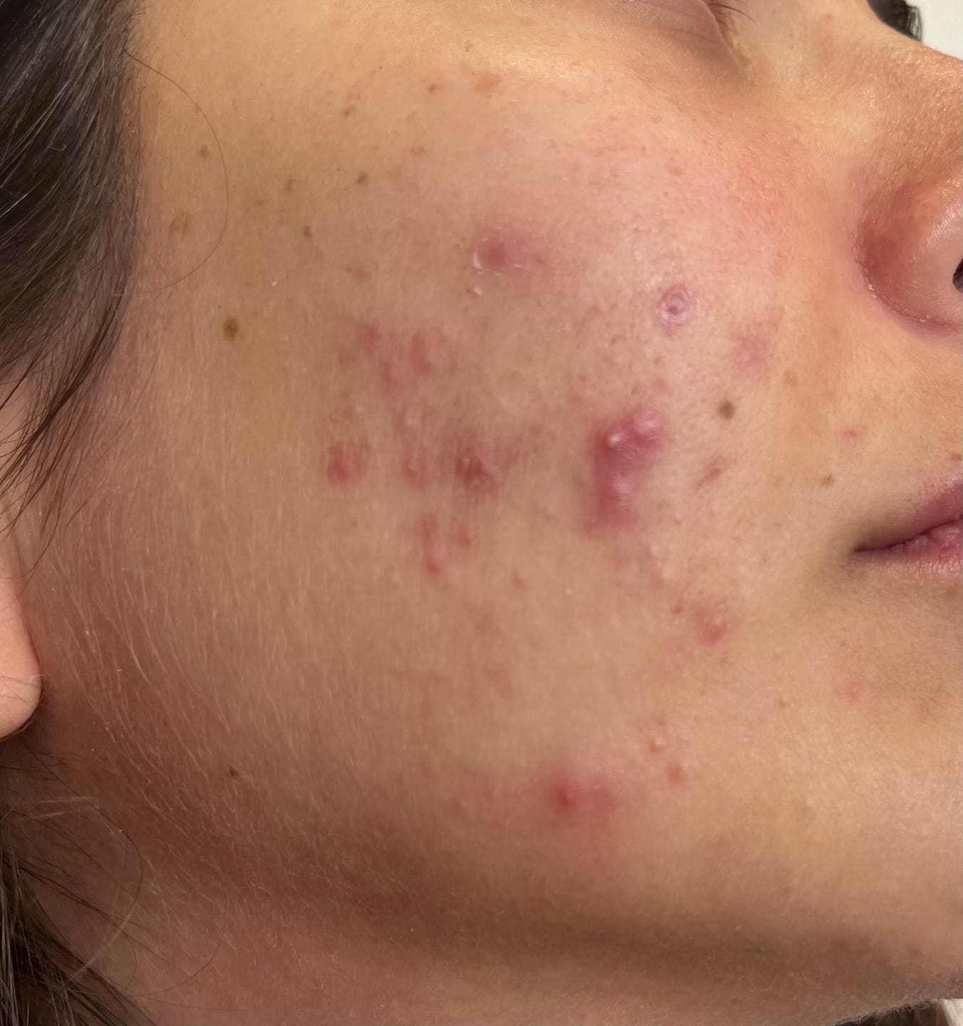 Customer photo review of A CONTROL - ACNÉ HORMONAL & RESISTENCIA A LA INSULINA