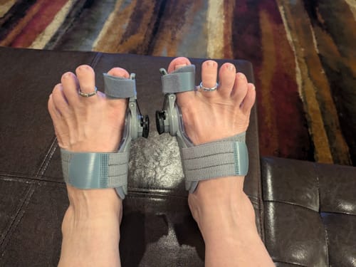 Customer photo review of Treatmedy™ Bunion Fix - Natural At-Home Bunion Relief