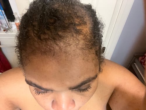 Customer photo review of Healthy Hair Starter Kit- Limited Edition