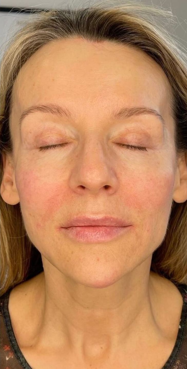 Customer photo review of Système de micro perfusion Glov Beauté