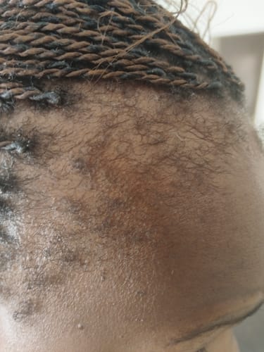 Customer photo review of Scalp Serum Set - Minoxidil