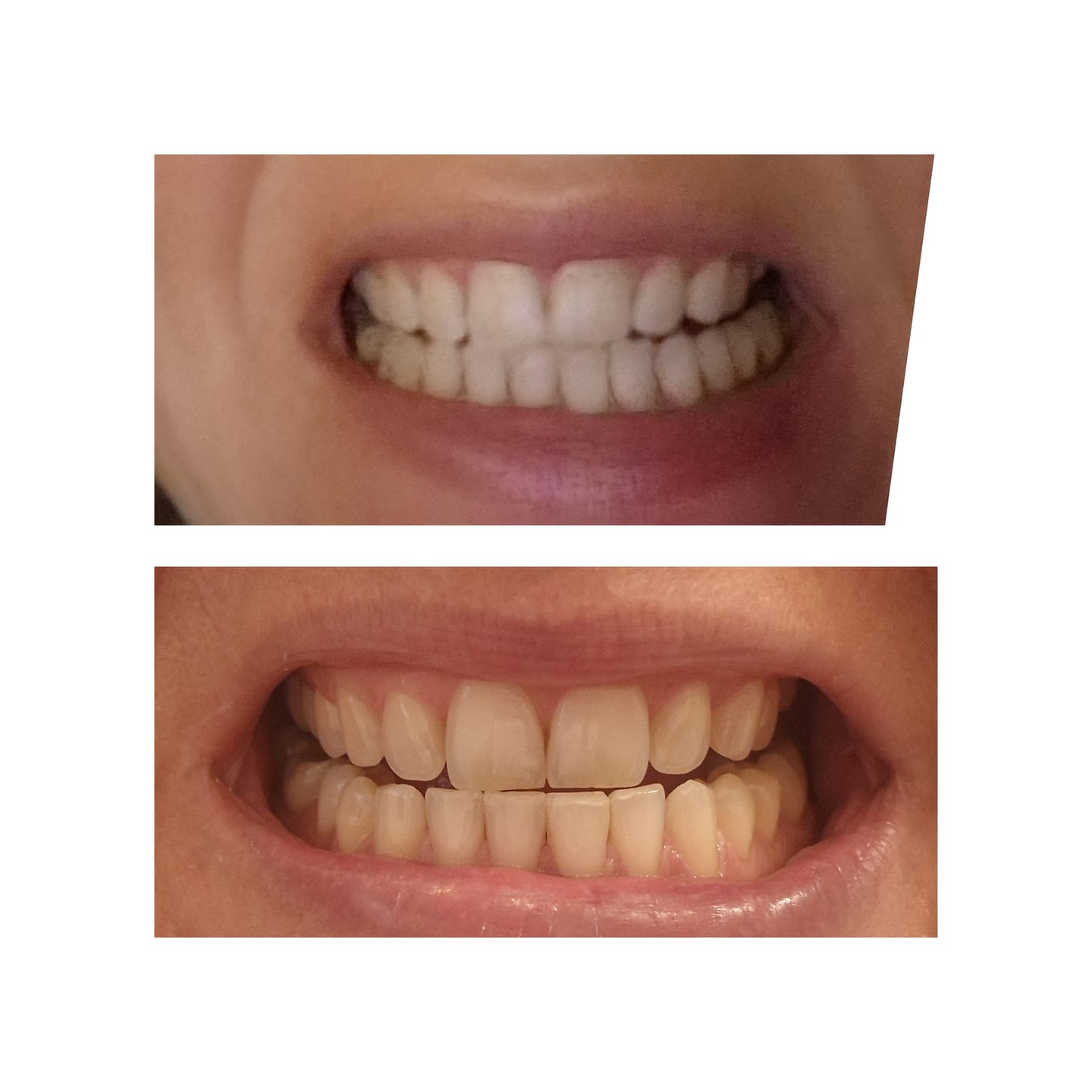 Customer photo review of Zahnbleaching-Set Rapid+ Dental Beauty - Teeth Whitening Kit