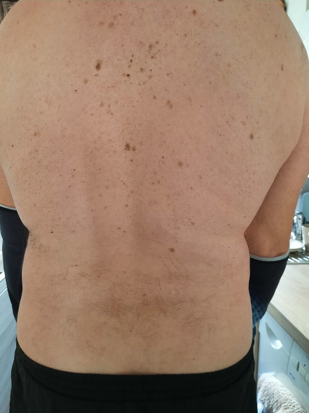 Customer photo review of 5x Belle Body Haarentfernung inkl. Gratis Enthaarungscreme