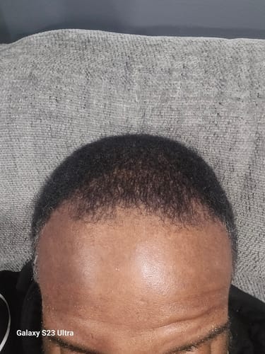 Customer photo review of Rennora Hair Growth Serum