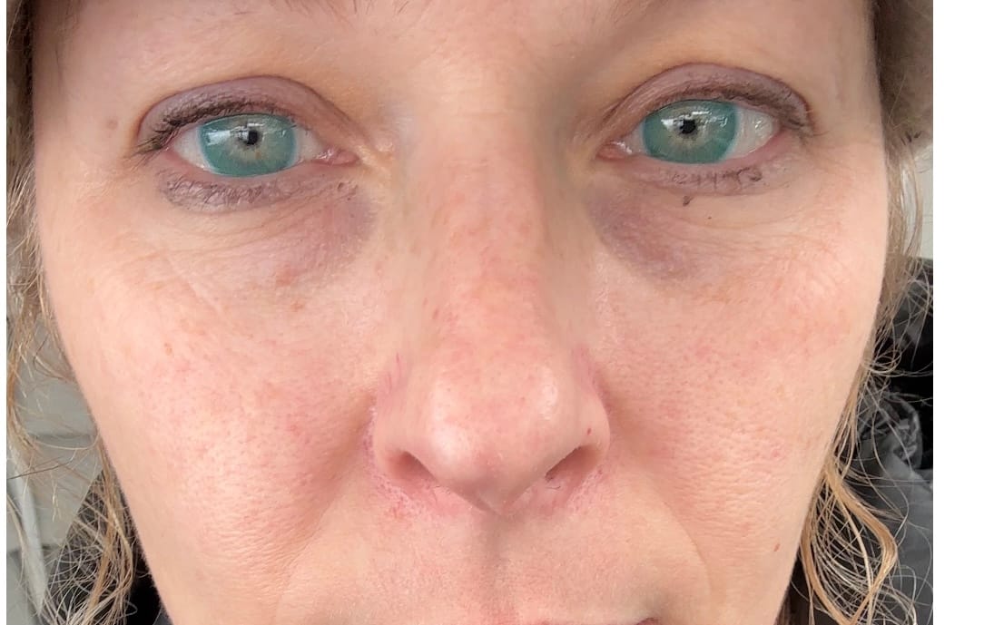 Customer photo review of Polar Light Blue Prescription Colored Contact Lenses