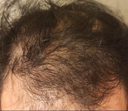 Customer photo review of Red Light Therapy Hat