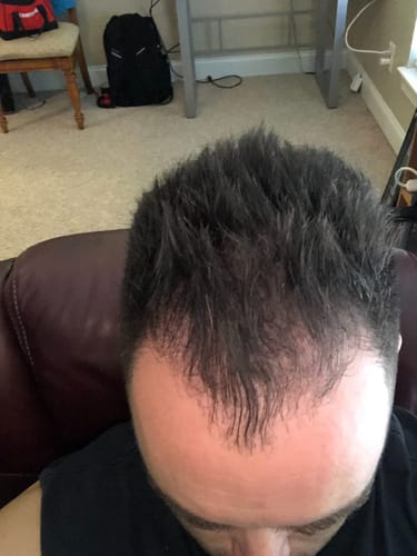 Customer photo review of Red Light Therapy Hat