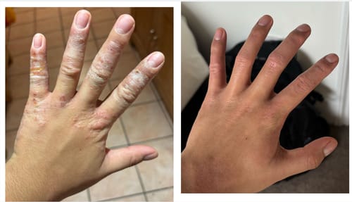 Customer photo review of Eczema Scratch Mitten
