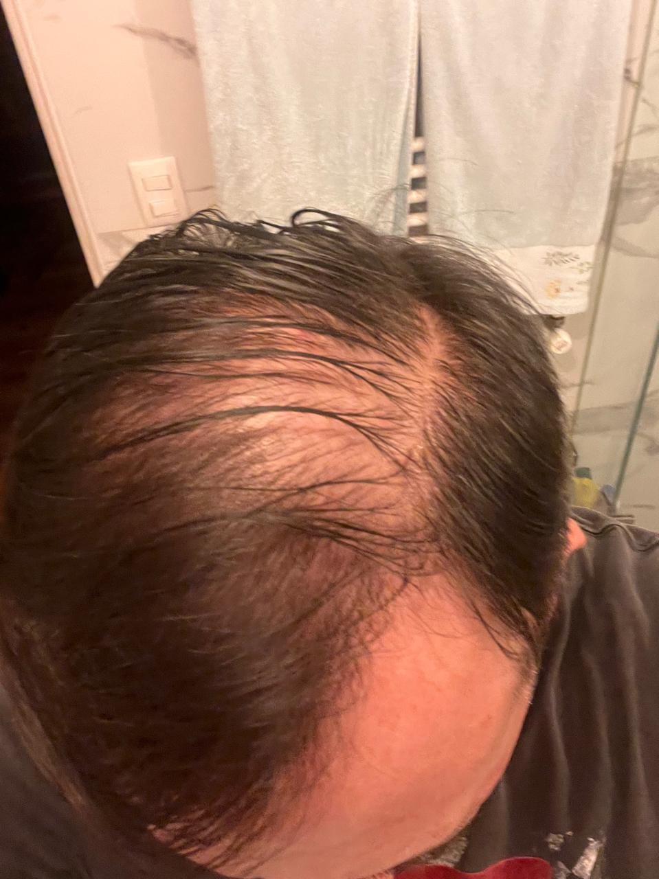 Customer photo review of 3 MESES de DÚO ANTIcaída CRECIMIENTO INTENSIVO Bomba + Tónico