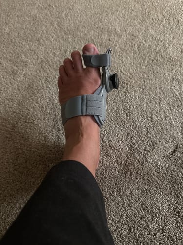 Customer photo review of Treatmedy™ Bunion Fix - Natural At-Home Bunion Relief