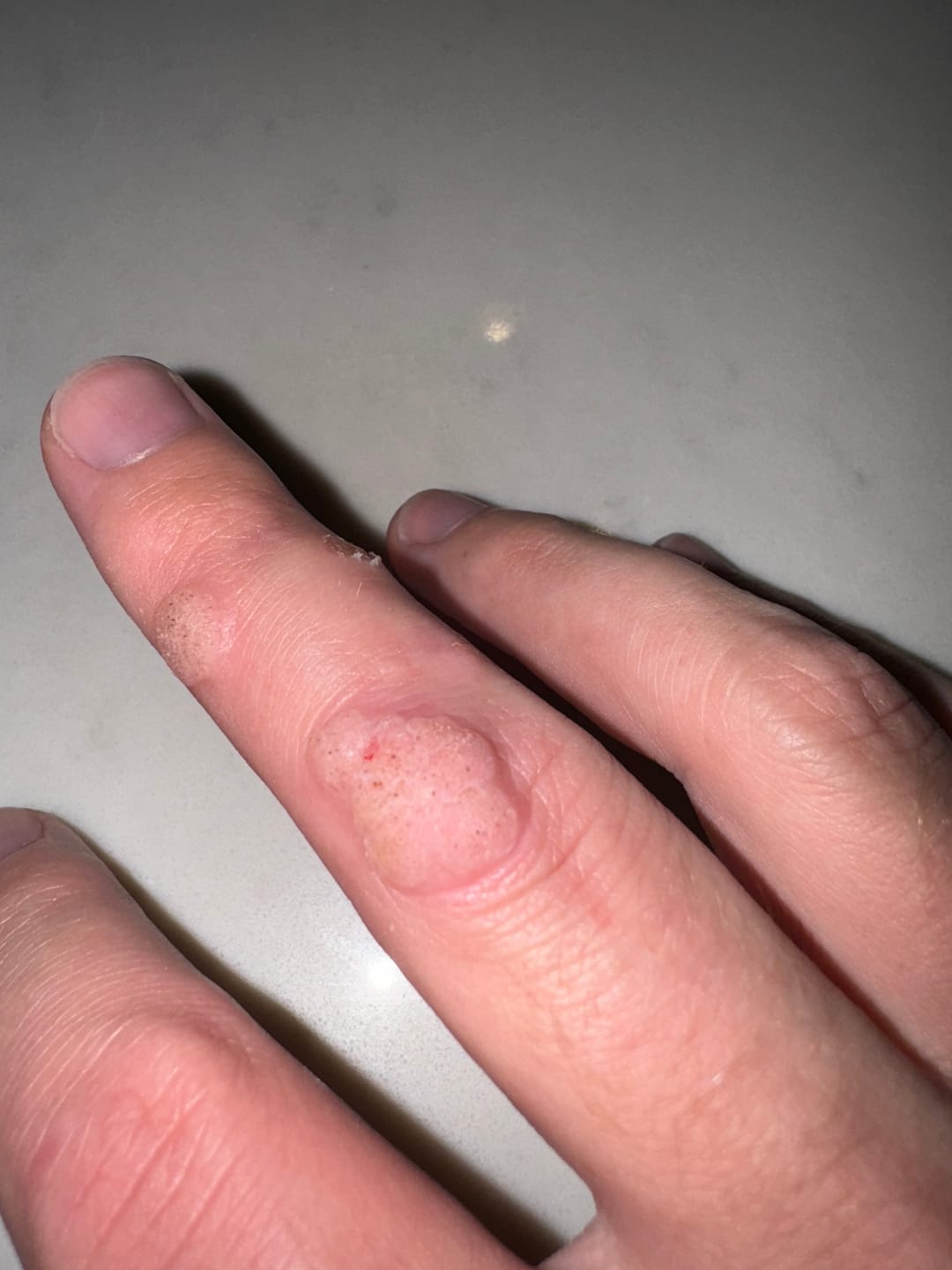Customer photo review of The Wartabater | Electronic Wart Remover | Safe, Easy, & Effective