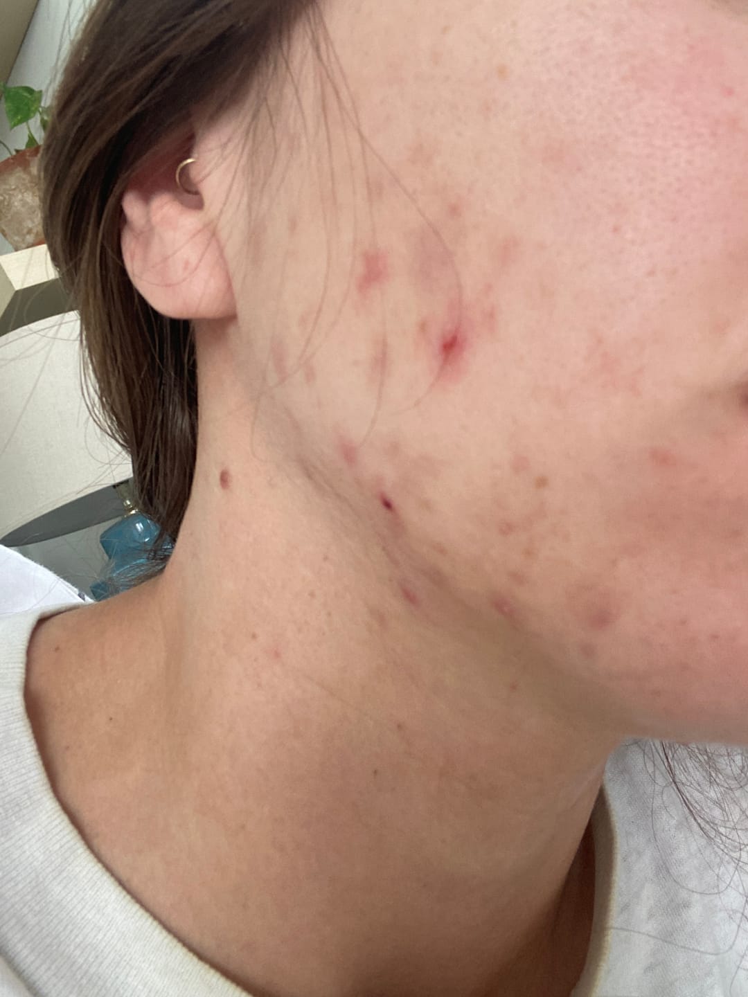 Customer photo review of Vegan PCOS Skin Health Supplement Bundle - Bundle & Save