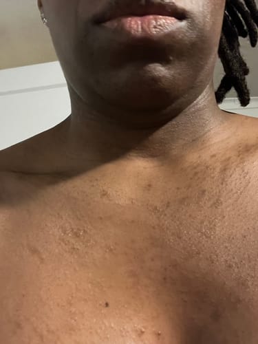 Customer photo review of Try me - Eczema & Psoriasis Relief Set (3 Flavors)